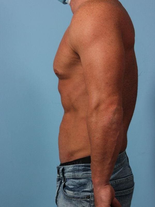 EMSCULPT Patient Photo - Case 14013 - after view-1