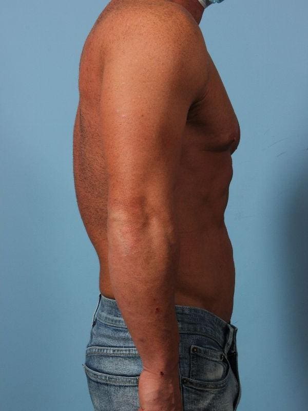 EMSCULPT Patient Photo - Case 14013 - after view-2