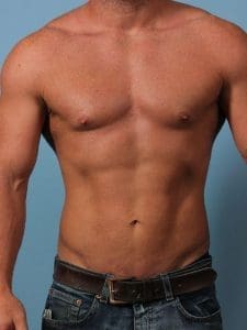 EMSCULPT - Case 14013 - Before