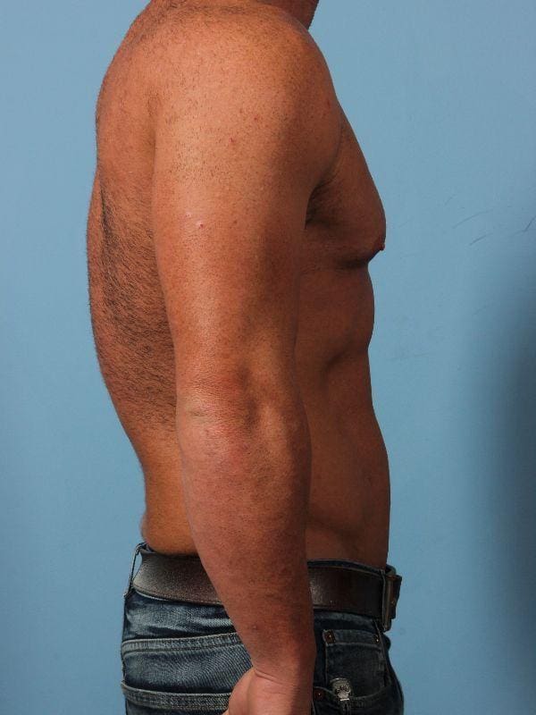 EMSCULPT Patient Photo - Case 14013 - before view-2