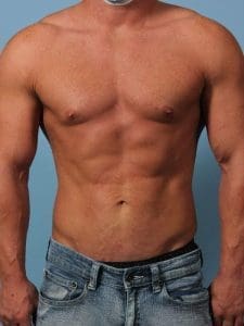 EMSCULPT - Case 14013 - After