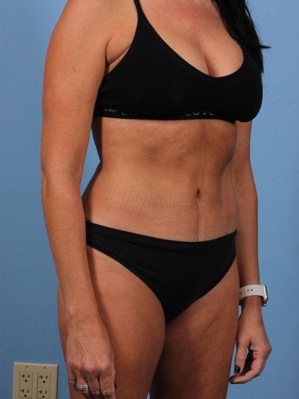 EMSCULPT Patient Photo - Case 14026 - after view-1