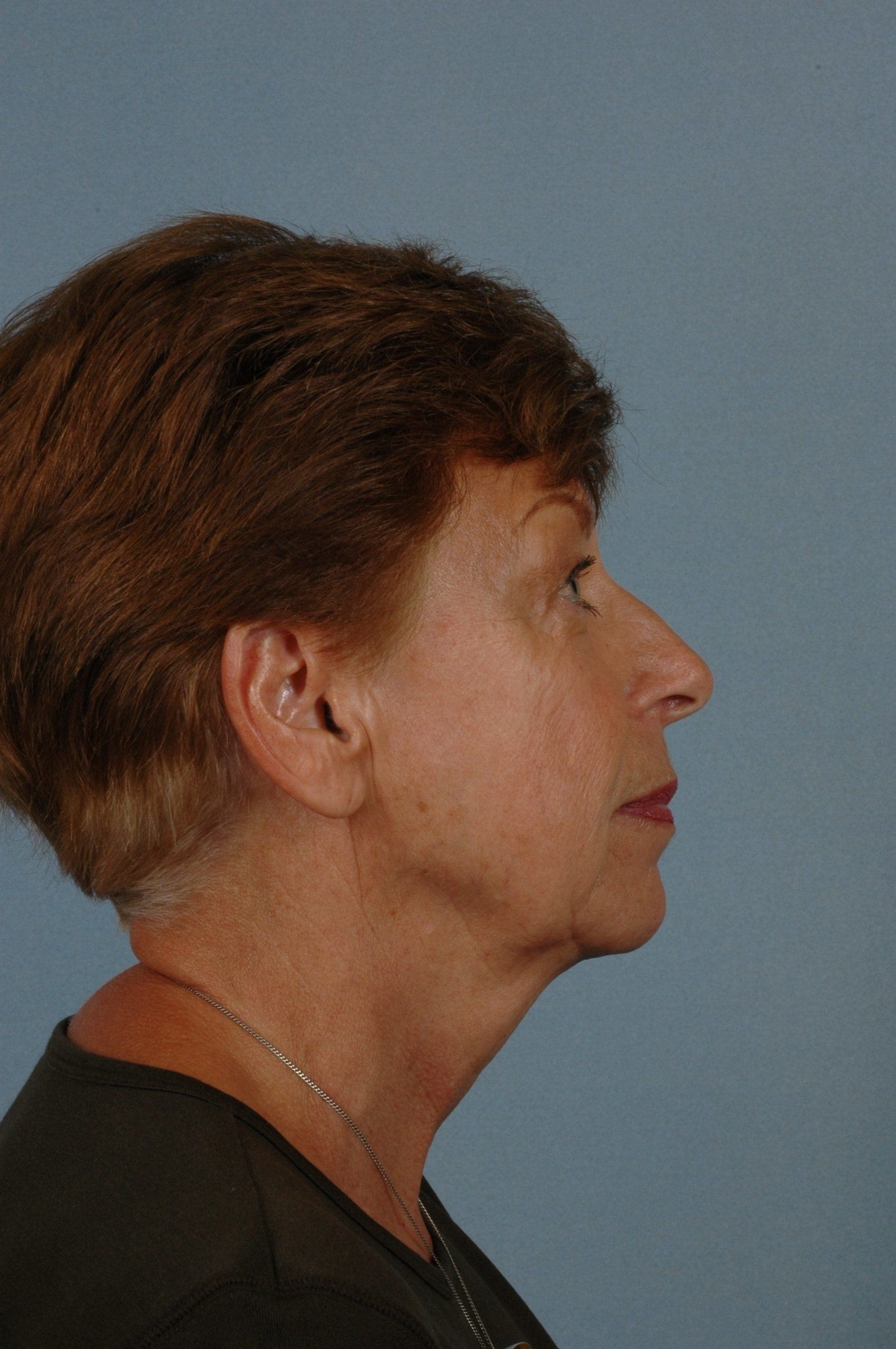 Eyelid Surgery Patient Photo - Case 14050 - before view-2