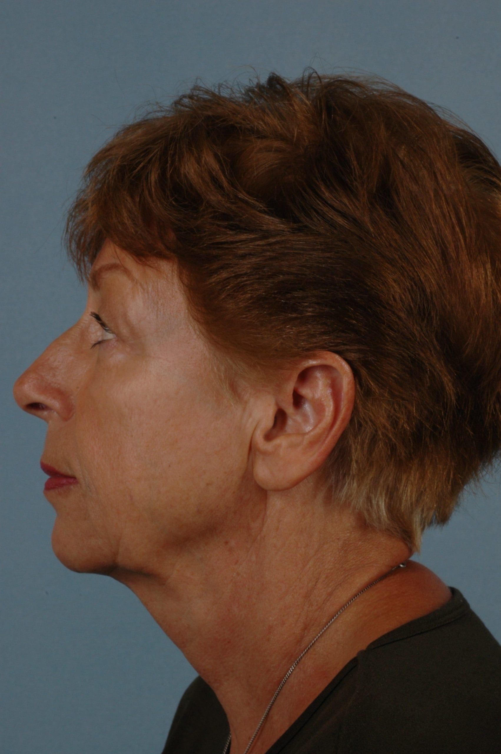 Eyelid Surgery Patient Photo - Case 14050 - before view-1