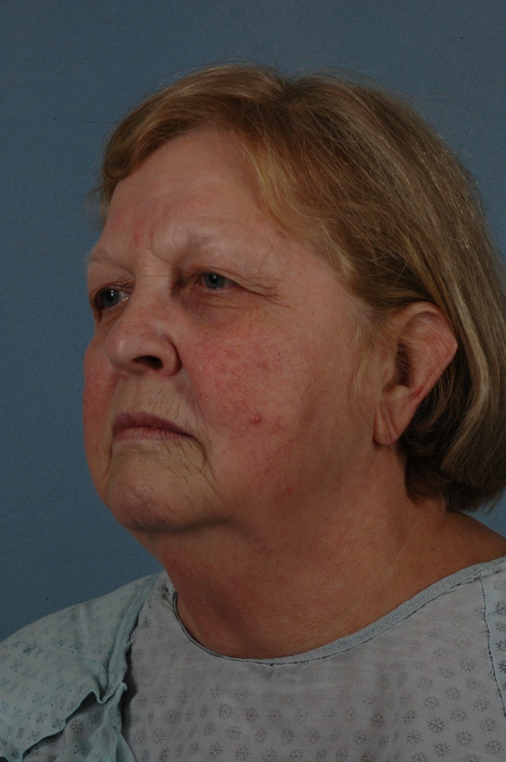 Eyelid Surgery Patient Photo - Case 14064 - before view-3