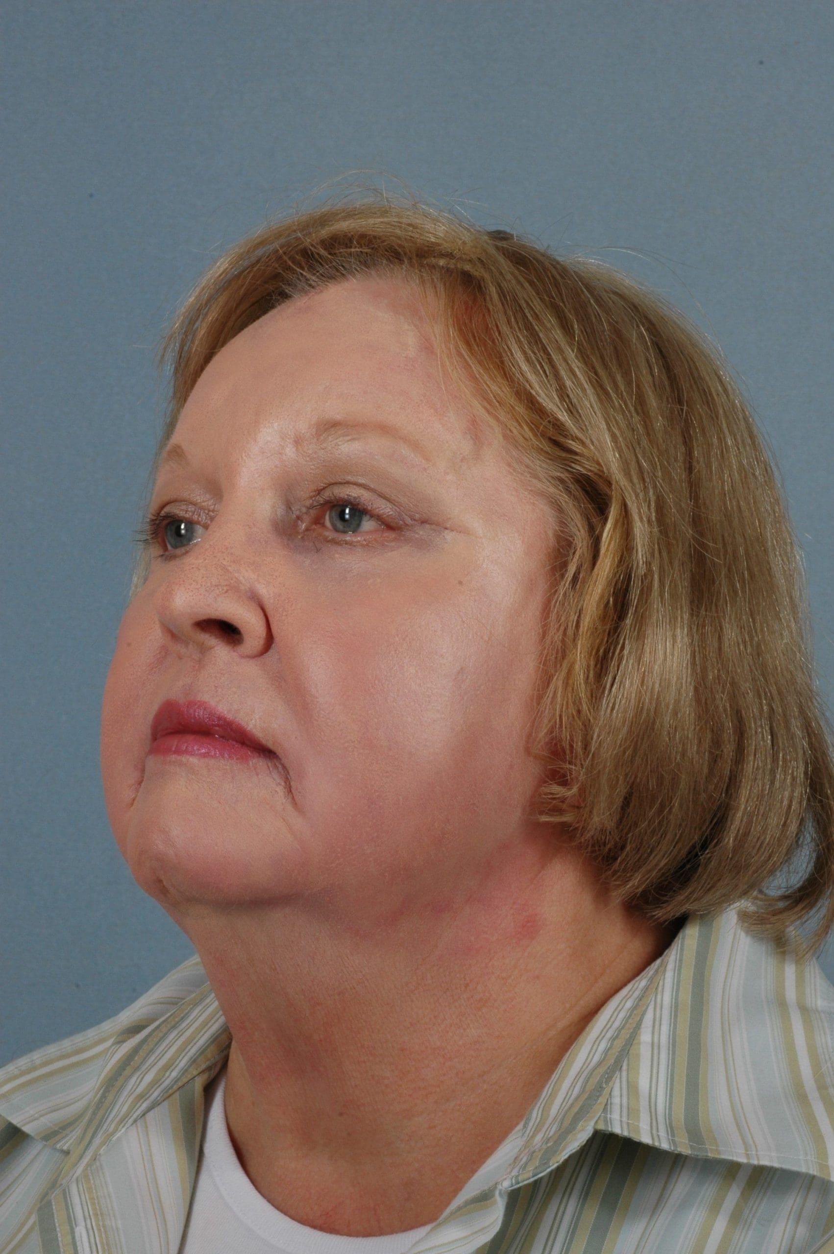 Eyelid Surgery Patient Photo - Case 14064 - after view-3