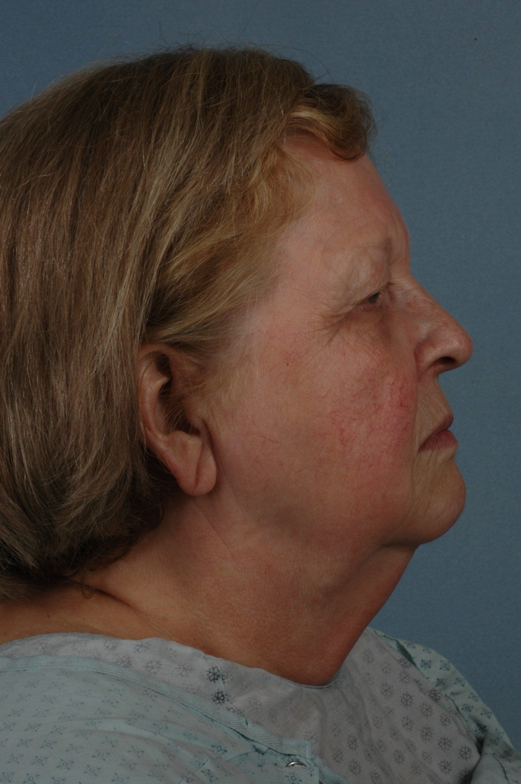 Eyelid Surgery Patient Photo - Case 14064 - before view-2