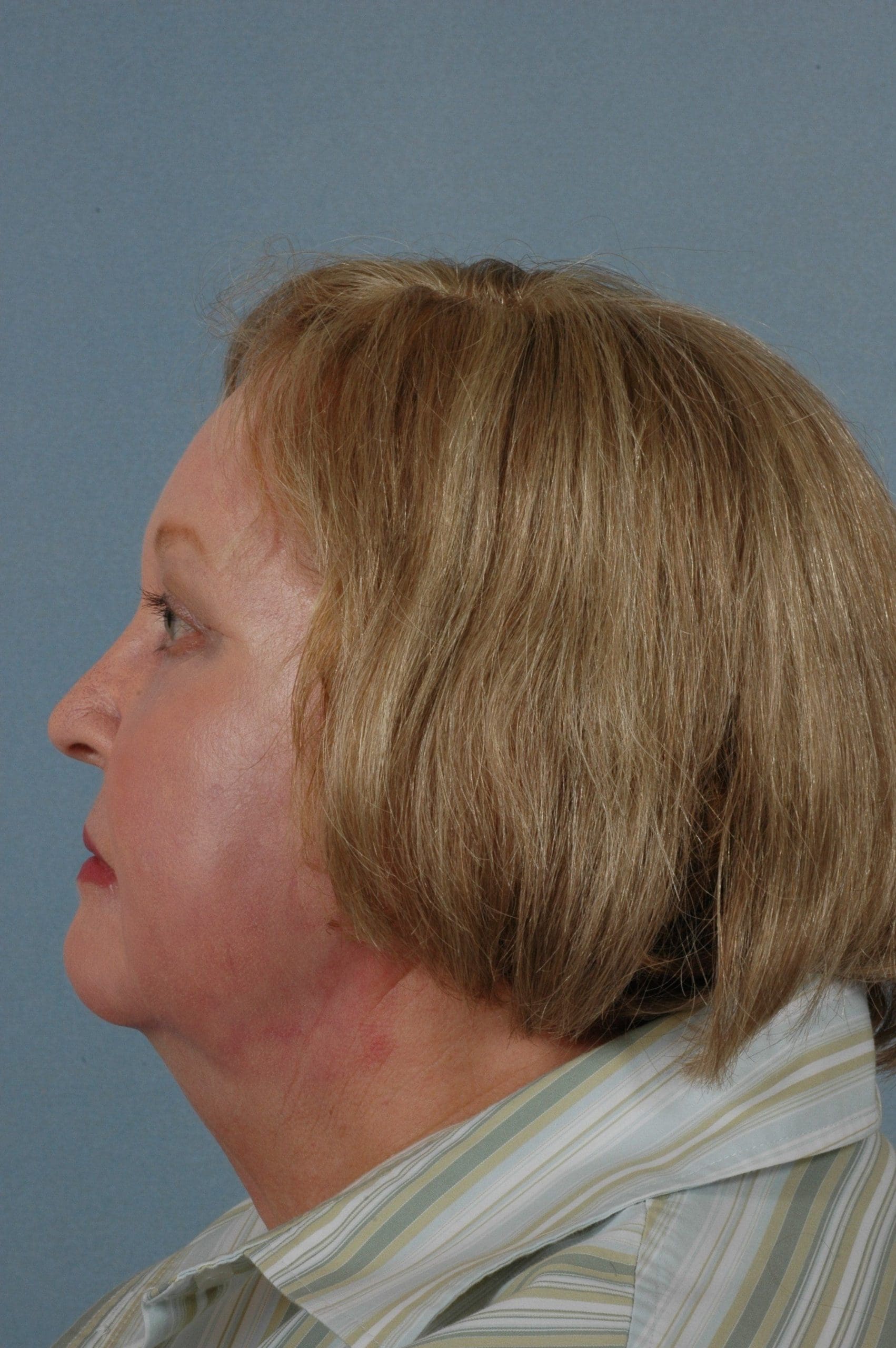 Eyelid Surgery Patient Photo - Case 14064 - after view-1