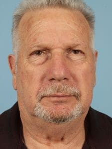 Eyelid Surgery - Case 14075 - Before