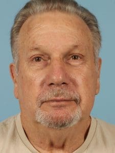 Eyelid Surgery - Case 14075 - After