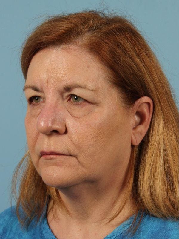 Eyelid Surgery Patient Photo - Case 14081 - before view-1