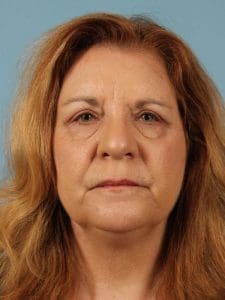 Eyelid Surgery - Case 14081 - After