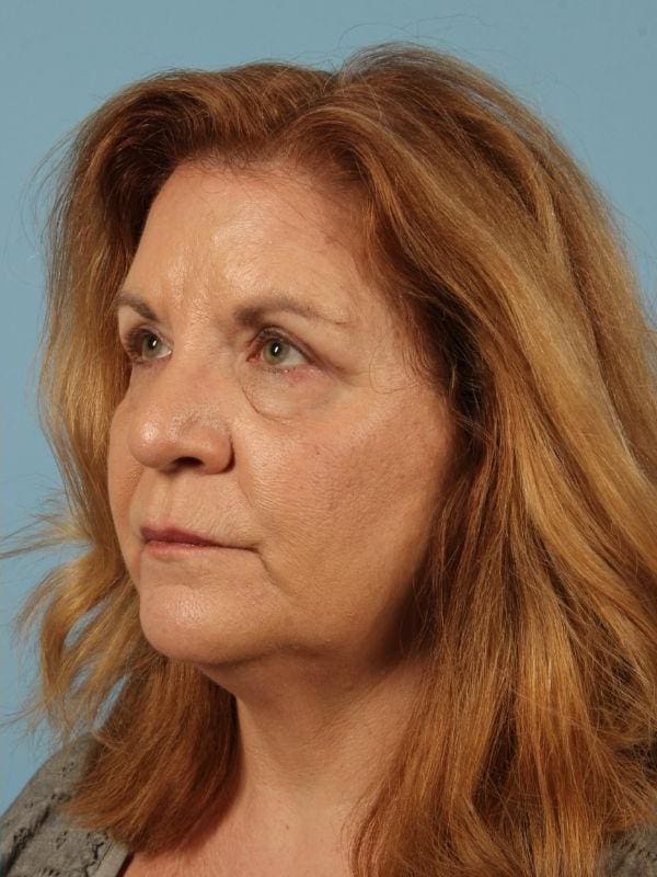 Eyelid Surgery Patient Photo - Case 14081 - after view-1