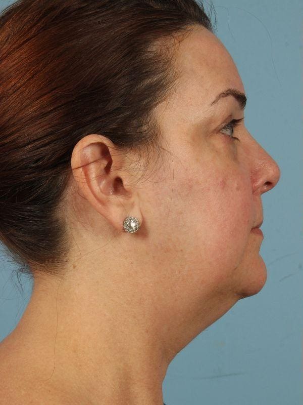 Eyelid Surgery Patient Photo - Case 14087 - before view-2