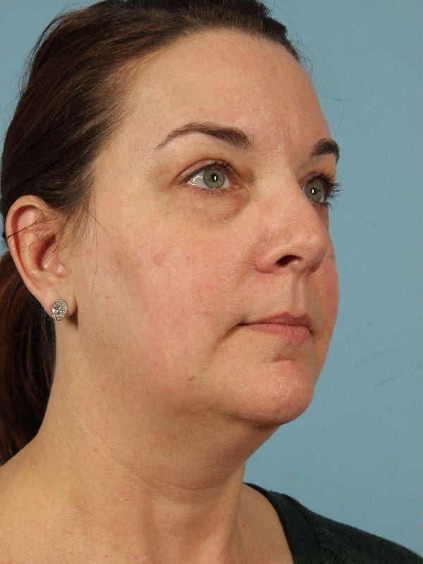 Eyelid Surgery Patient Photo - Case 14087 - before view-4