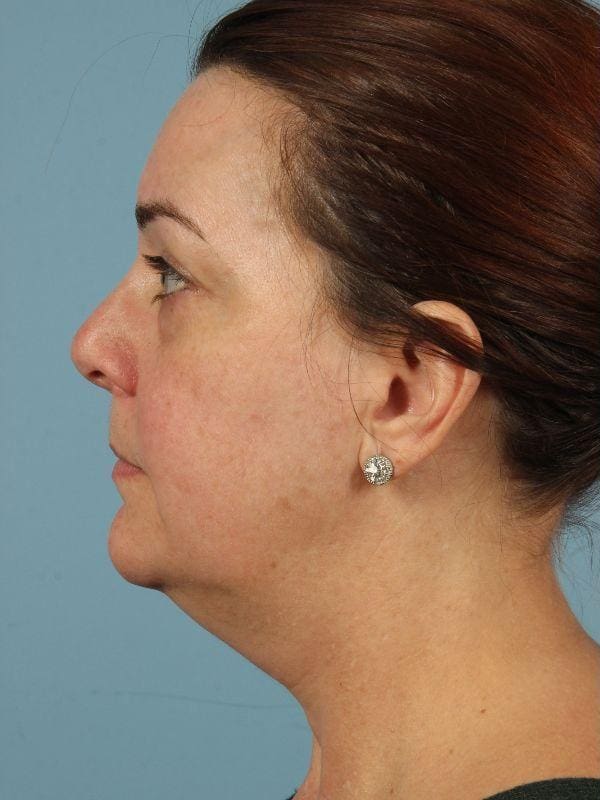 Eyelid Surgery Patient Photo - Case 14087 - before view-1