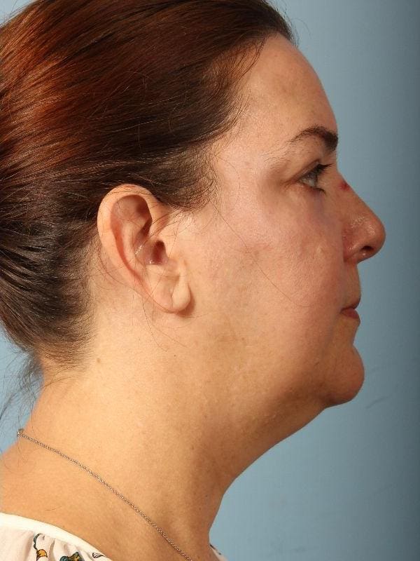 Eyelid Surgery Patient Photo - Case 14087 - after view-2