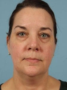 Eyelid Surgery - Case 14087 - Before