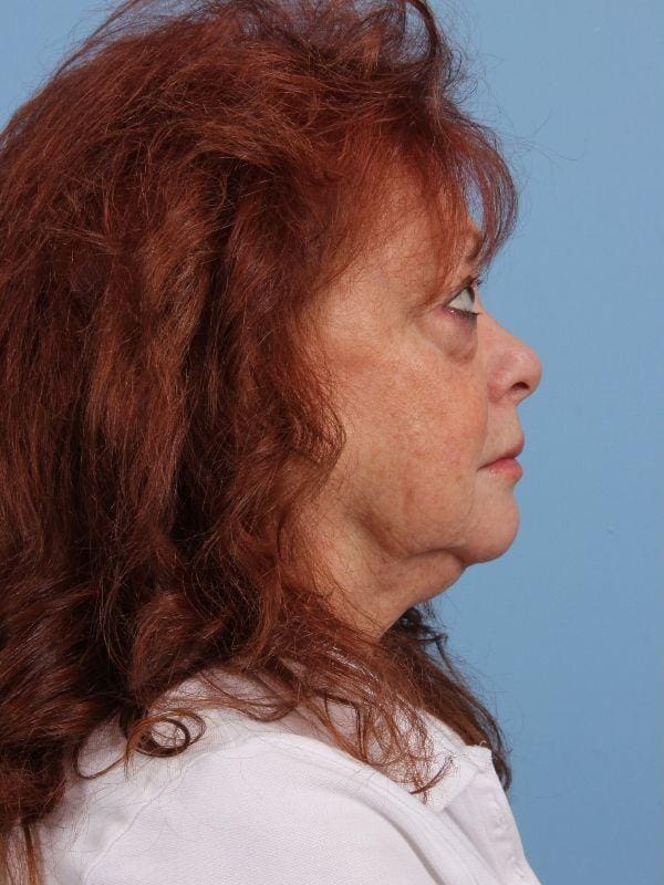 Eyelid Surgery Patient Photo - Case 14099 - before view-2