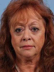 Eyelid Surgery - Case 14099 - After