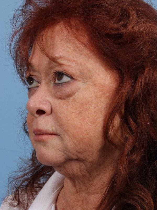 Eyelid Surgery Patient Photo - Case 14099 - before view-3