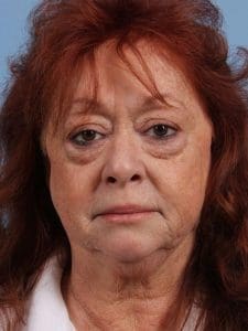 Eyelid Surgery - Case 14099 - Before