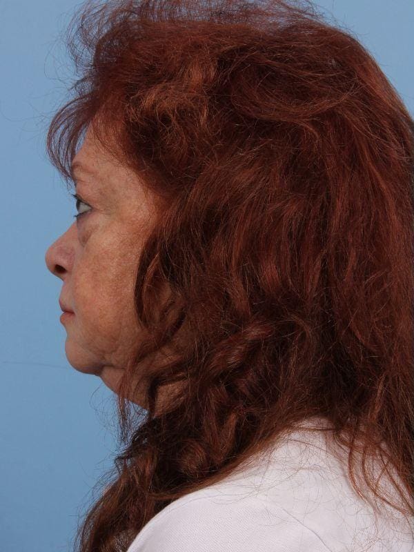 Eyelid Surgery Patient Photo - Case 14099 - before view-1