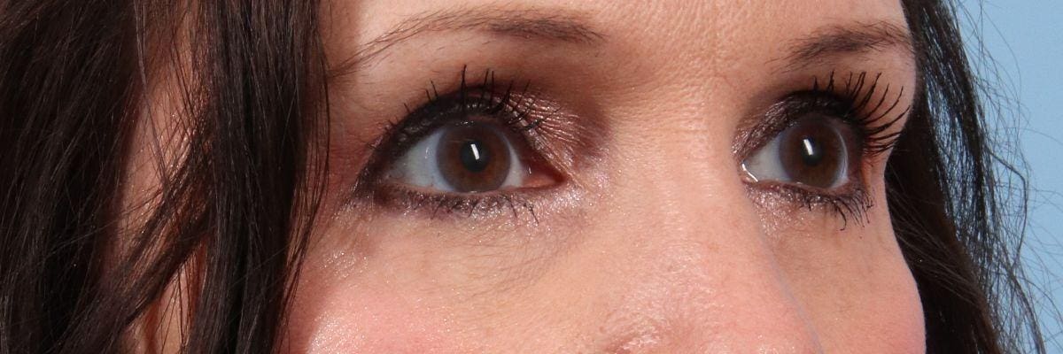 Eyelid Surgery Patient Photo - Case 14111 - after view-2