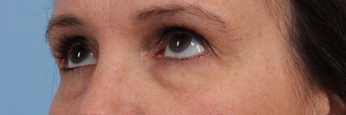 Eyelid Surgery Patient Photo - Case 14111 - before view-1