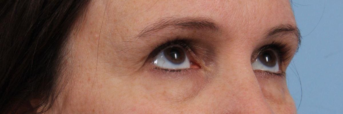 Eyelid Surgery Patient Photo - Case 14111 - before view-2