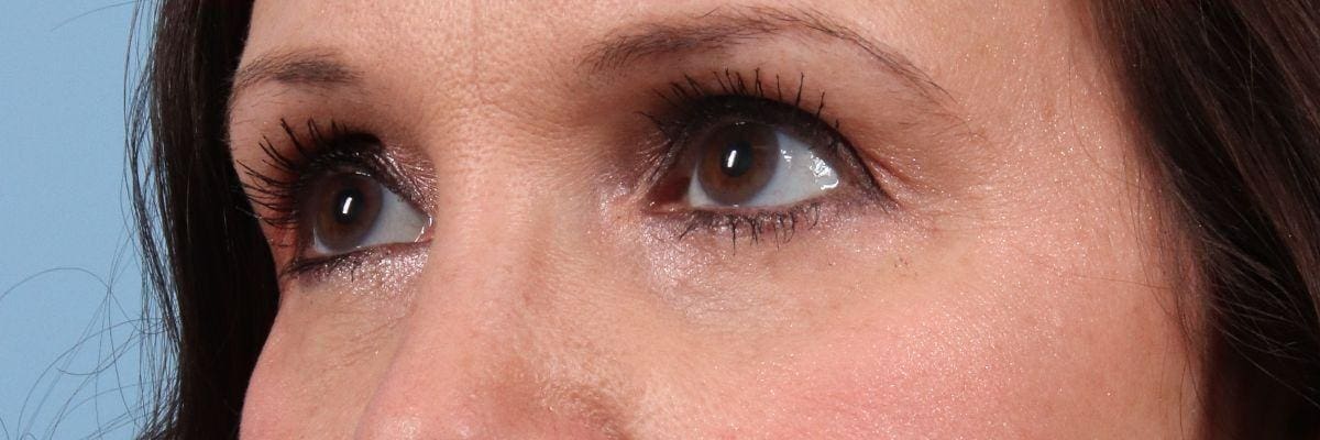 Eyelid Surgery Patient Photo - Case 14111 - after view-1