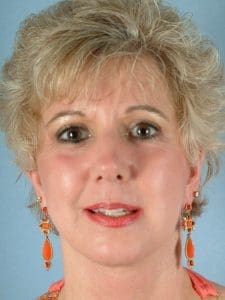 Facelift - Case 14119 - After