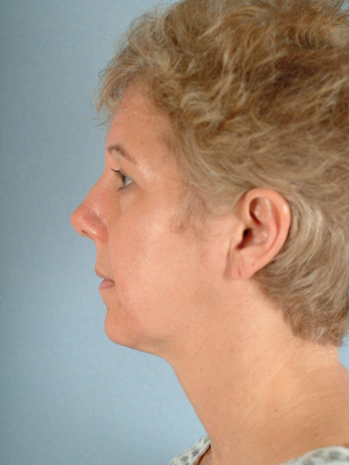 Facelift Patient Photo - Case 14119 - before view-1