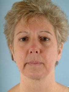 Facelift - Case 14119 - Before
