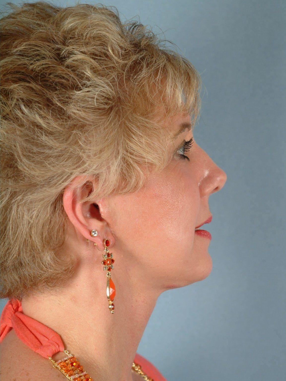 Facelift Patient Photo - Case 14119 - after view-2