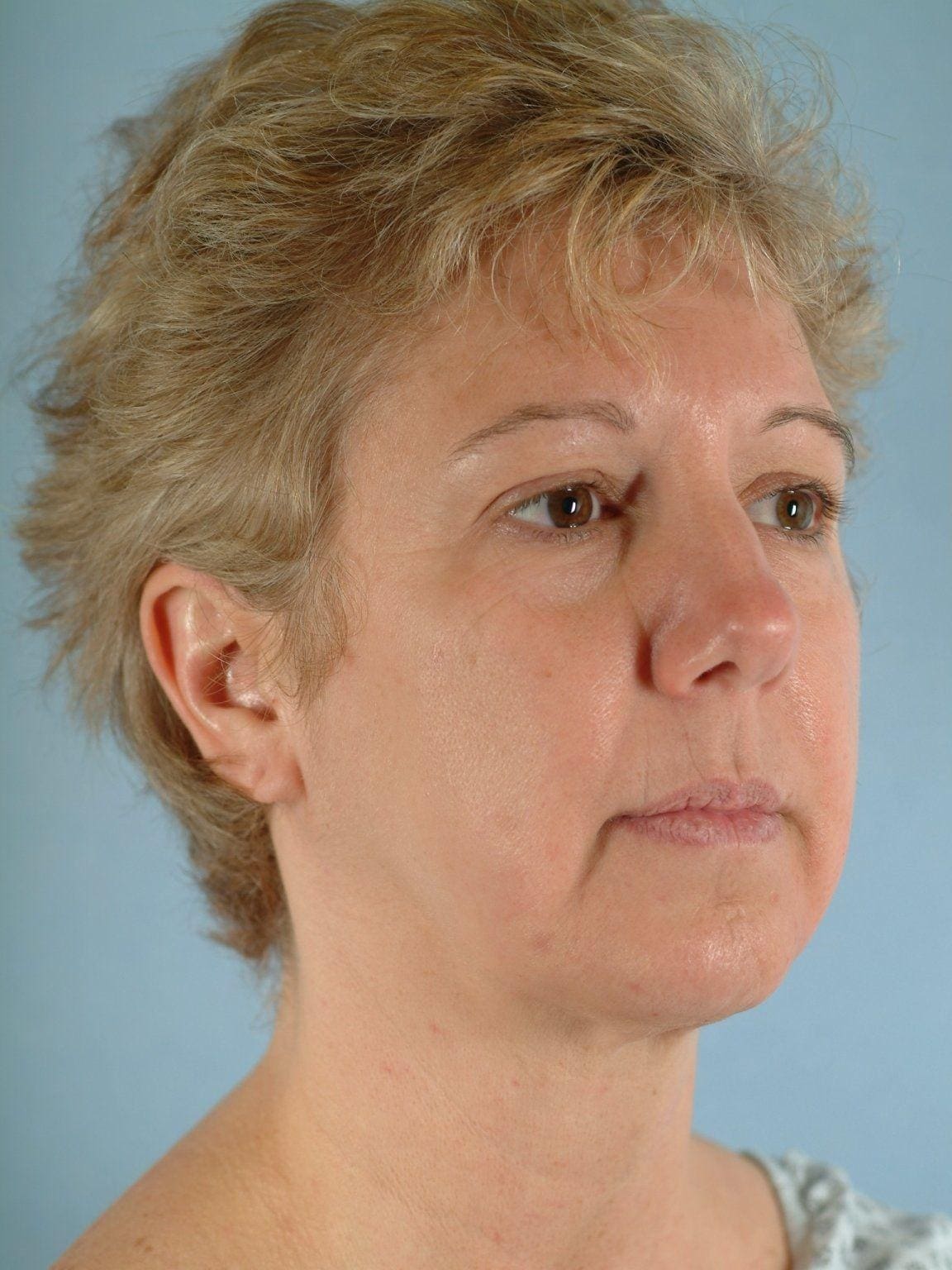Facelift Patient Photo - Case 14119 - before view-4