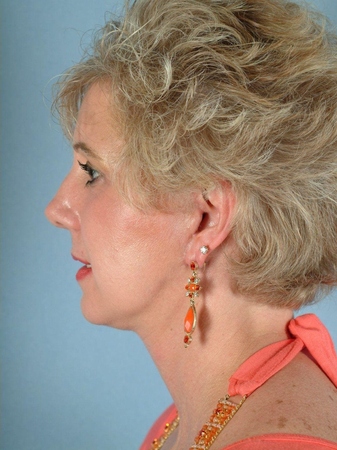 Facelift Patient Photo - Case 14119 - after view-1