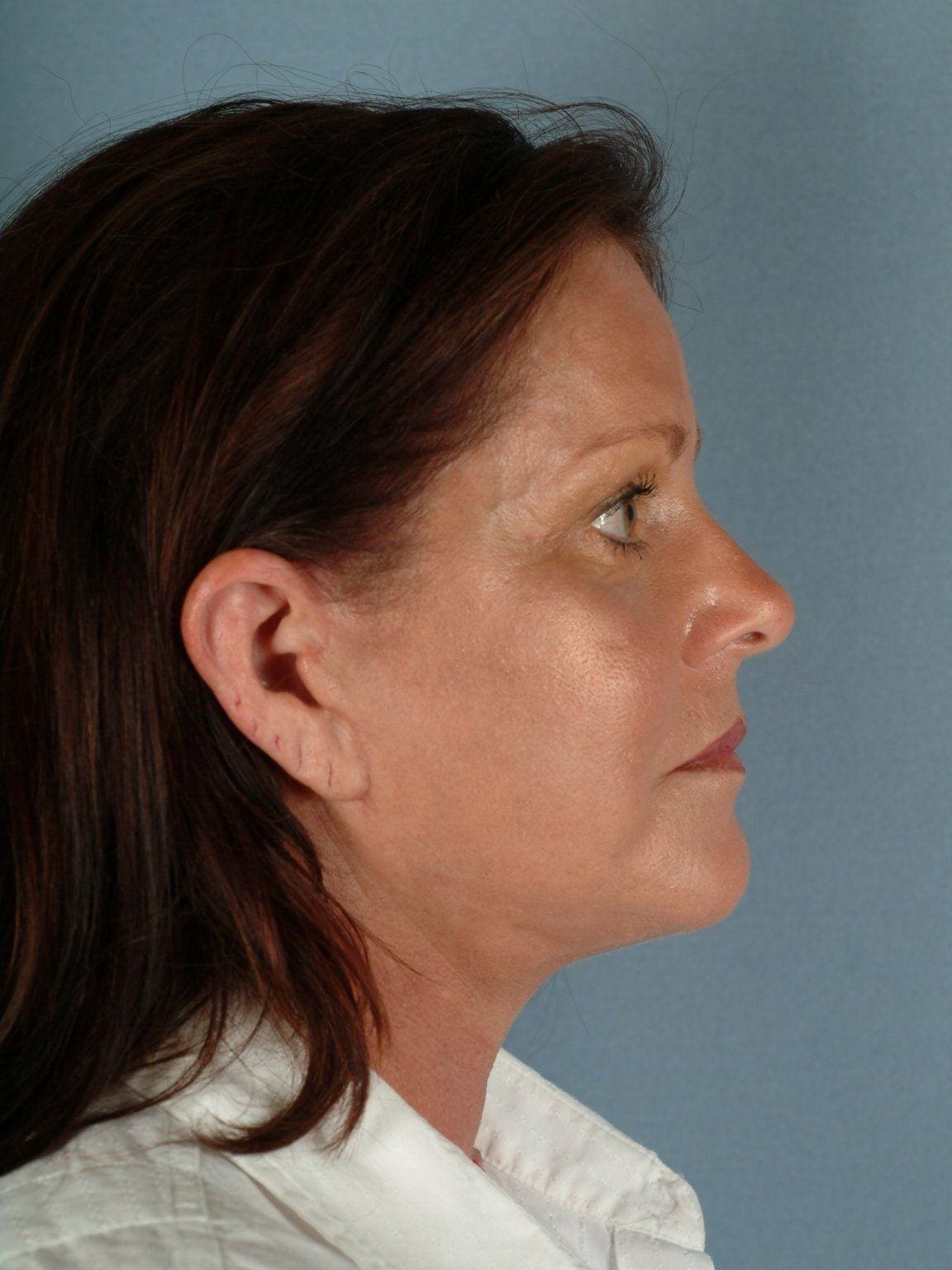 Facelift Patient Photo - Case 14132 - after view-2