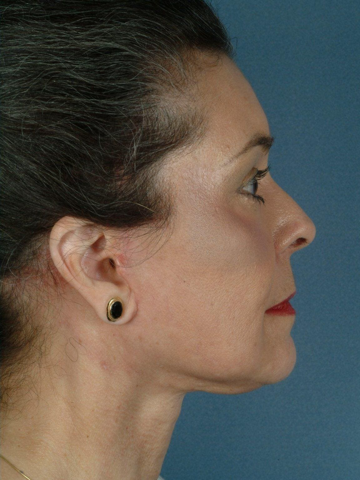 Facelift Patient Photo - Case 14144 - after view-2
