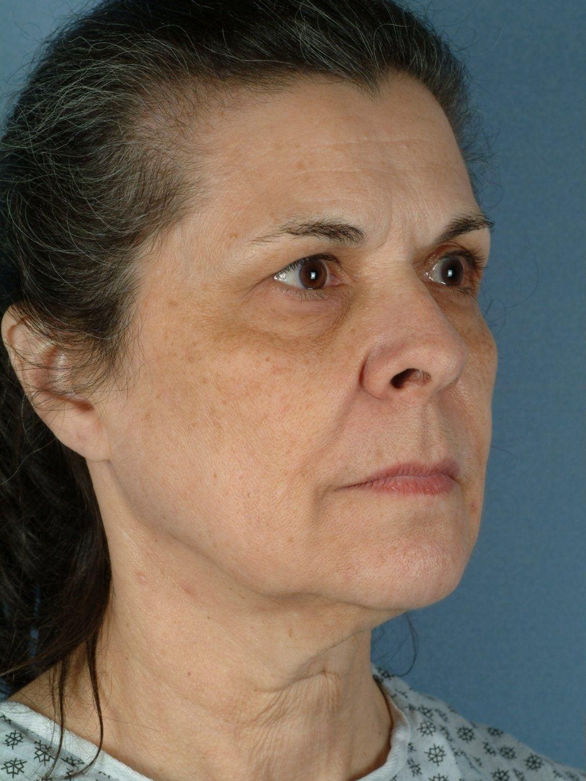 Facelift Patient Photo - Case 14144 - before view-4