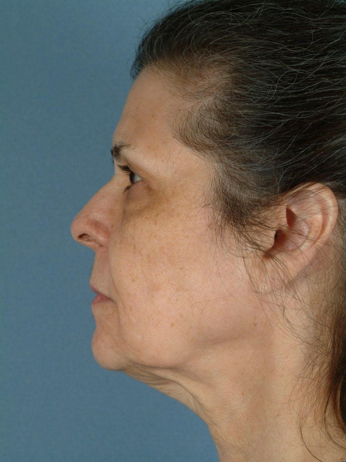 Facelift Patient Photo - Case 14144 - before view-1