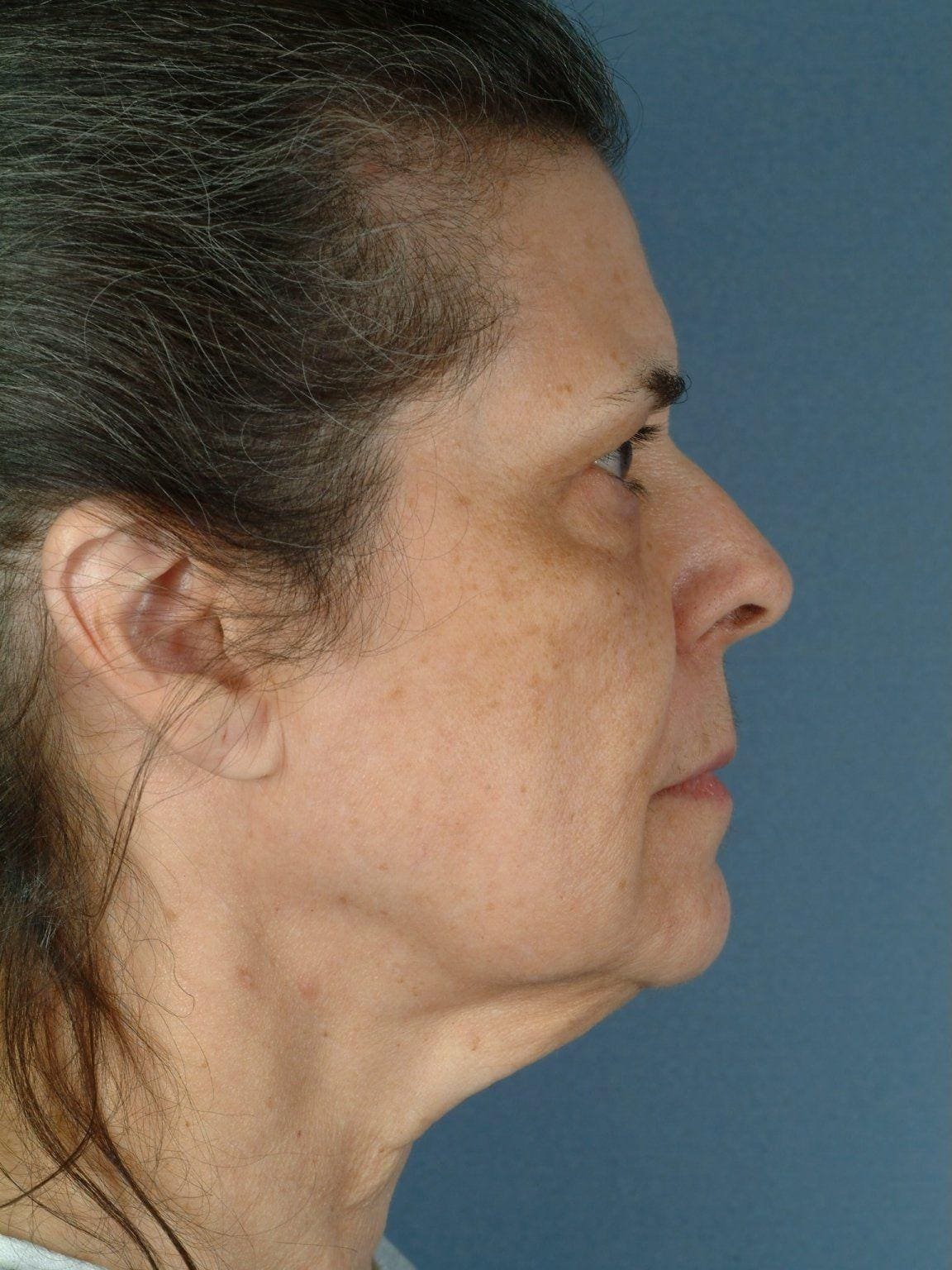 Facelift Patient Photo - Case 14144 - before view-2