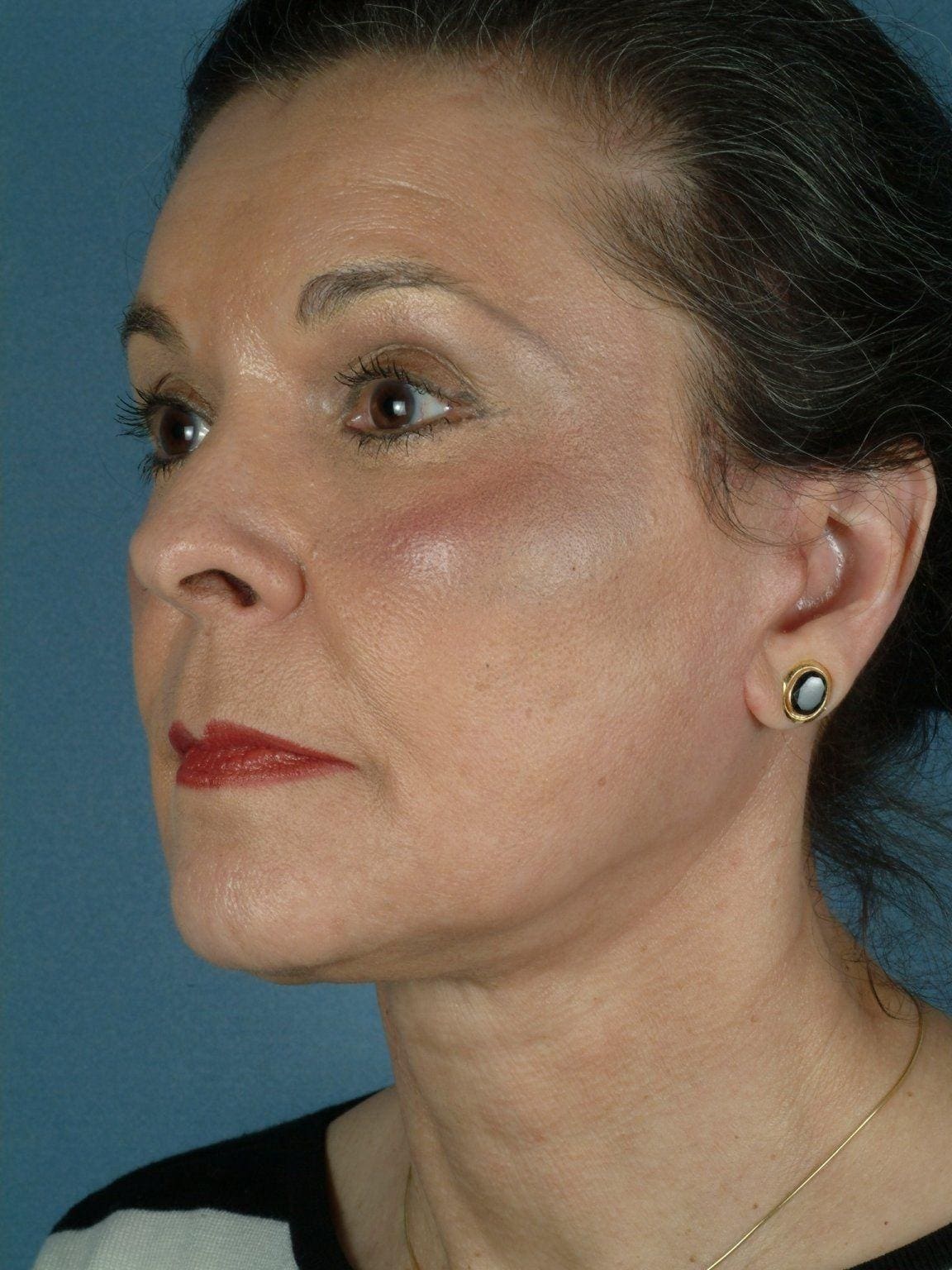 Facelift Patient Photo - Case 14144 - after view-3
