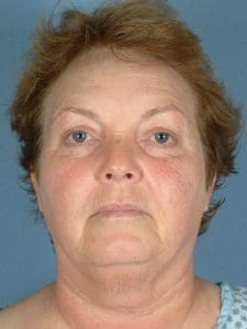 Facelift - Case 14156 - Before