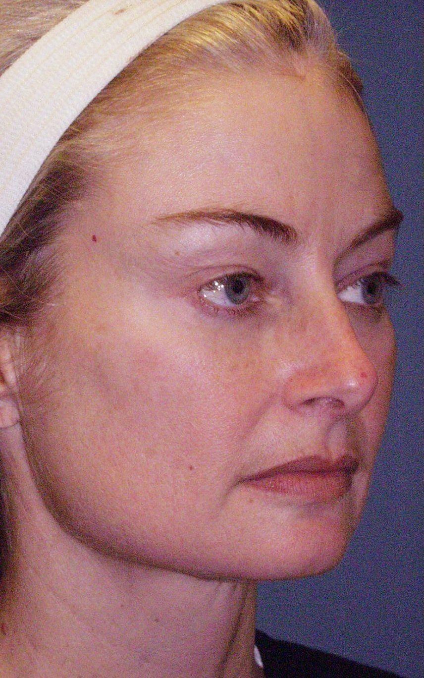 Facelift Patient Photo - Case 14168 - before view-3