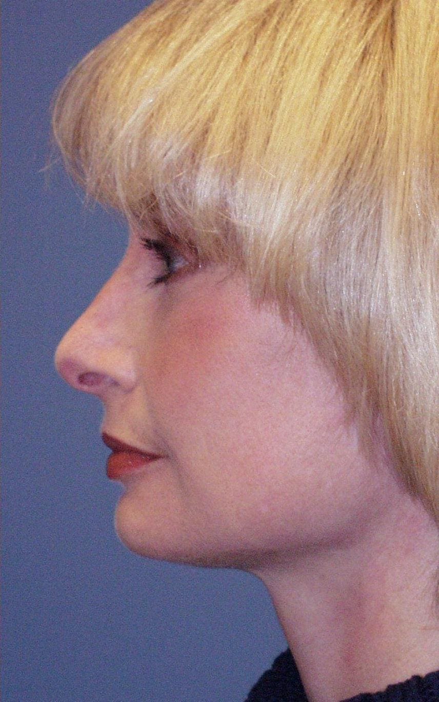Facelift Patient Photo - Case 14168 - after view-1