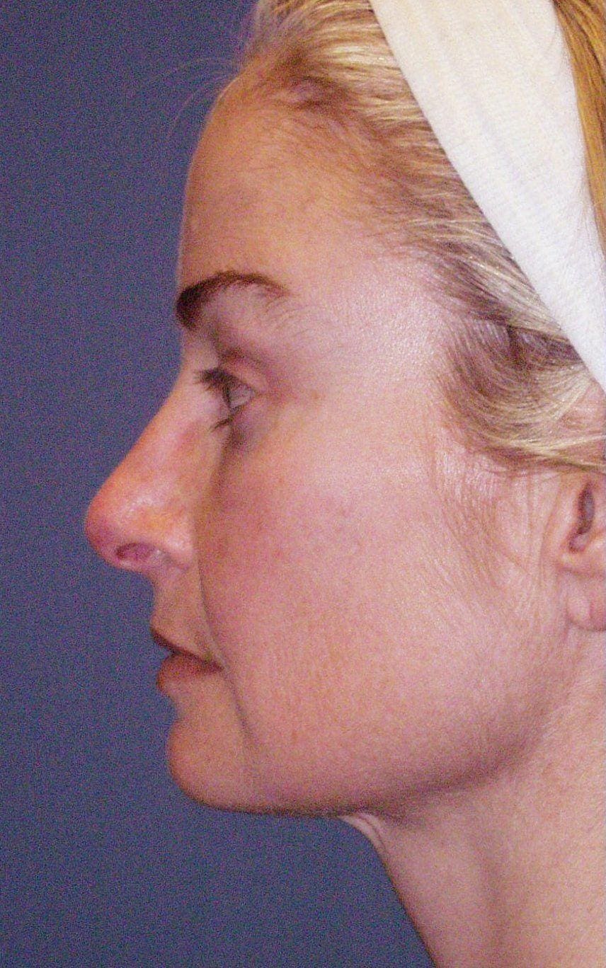 Facelift Patient Photo - Case 14168 - before view-1