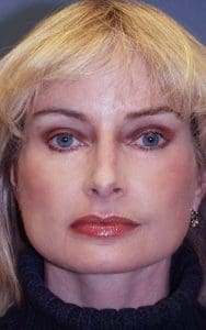 Facelift - Case 14168 - After