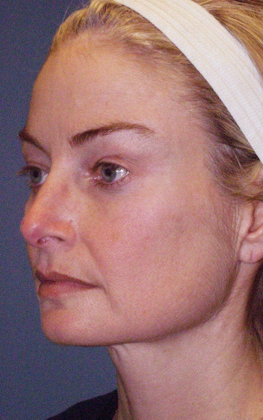Facelift Patient Photo - Case 14168 - before view-2