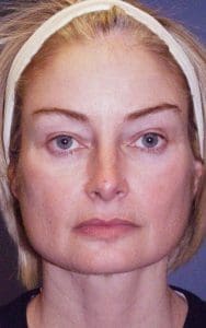 Facelift - Case 14168 - Before